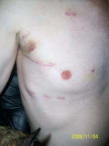 Mitral Valve Surgery Post Op