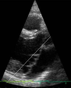 Echo Cardiogram Mitral Valve Prolapse