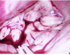 Mitral Valve Prolapse Picture - Before
